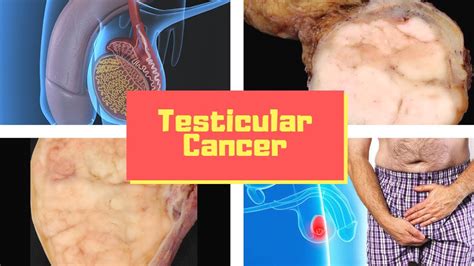 No matter what, if you find a lump, tell your doctor. . Testicular cancer lump picture